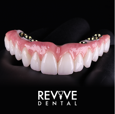 Hybrid Implant Bridge