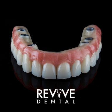 Zirconia Implant Bridge