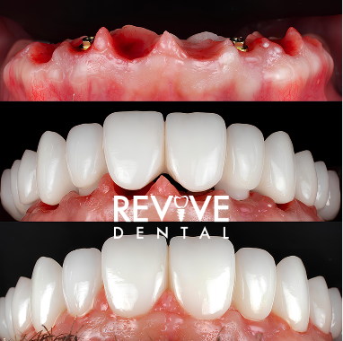 Porcelain Implant Bridge